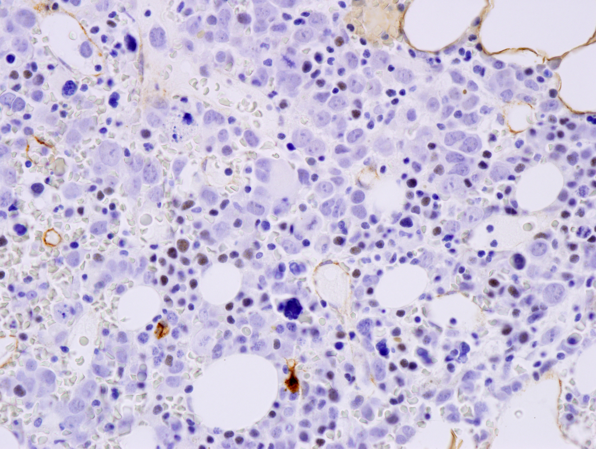 Bone marrow core biopsy CD34 400x